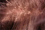 Scalp Dandruff photo